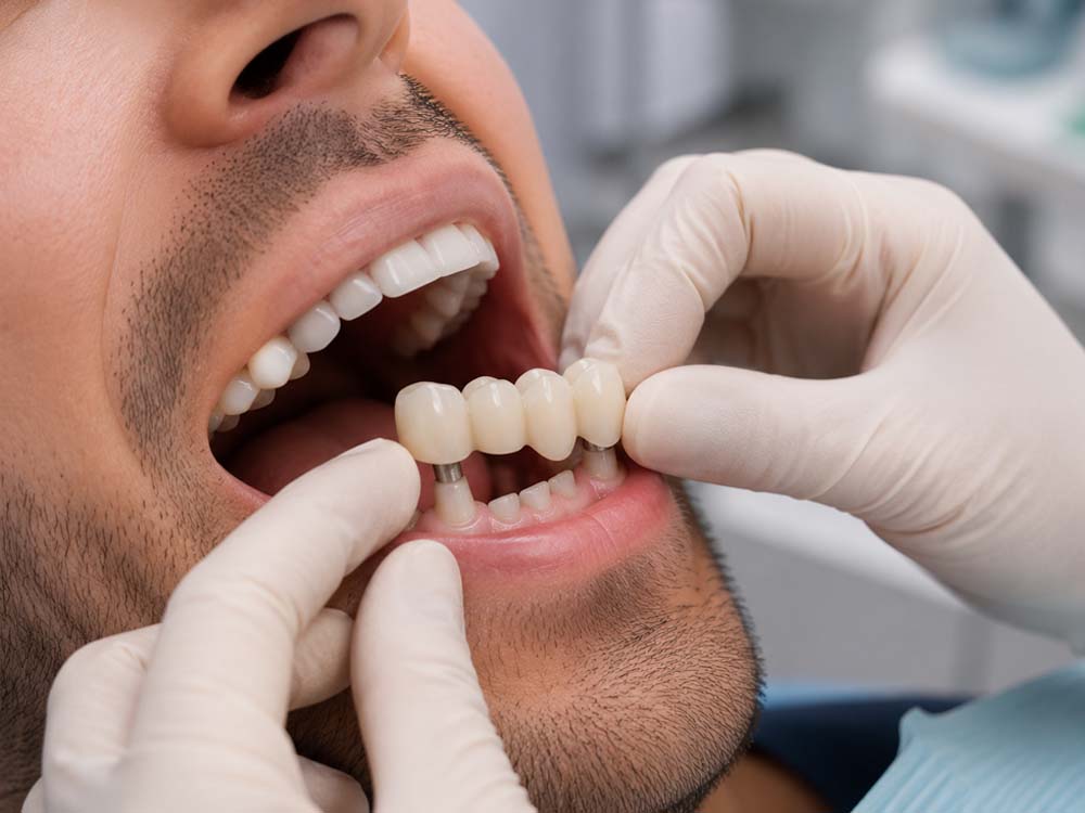 protesis dentales en córdoba. Clinica dental especializada en protesis dentales en Santa Rosa.