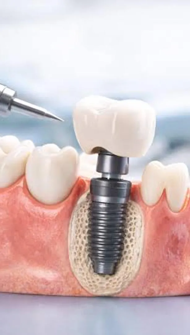 rehabilitacion completa sobre implantes córdoba.